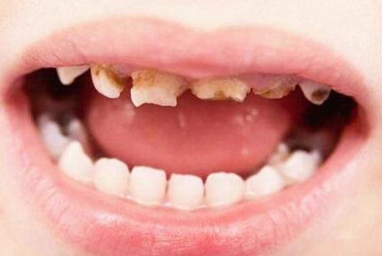 十牙九蛀,关于"小黑牙"的秘密都在这,了解蛀牙的秘密与防治
