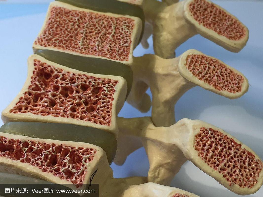 脊柱和椎体横切面解剖模型显示骨质疏松症的不同阶段