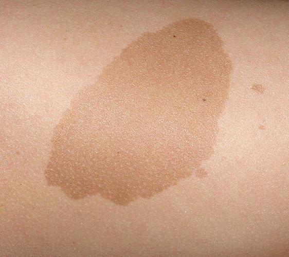 咖啡斑是一种色素增加性皮肤病,由于疾病本身的特点,咖啡斑会不断的