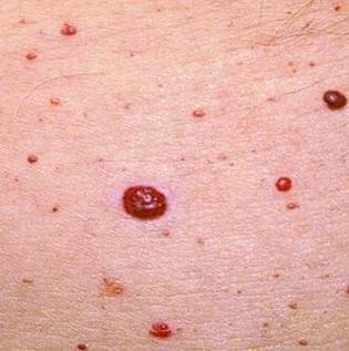 辟谣:乙肝患者皮肤出现红点,表示病情恶化?听听肝病医生怎么说