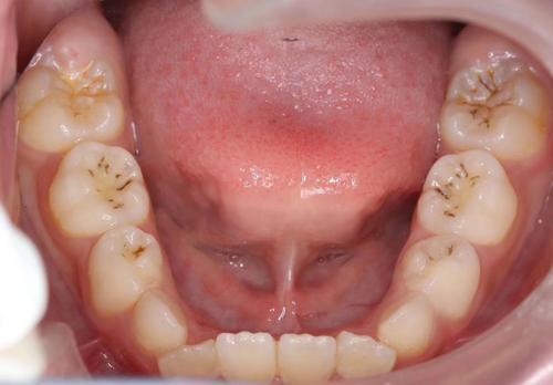 牙齿上的"黑线"是怎么回事?医生劝告:最好不要用手抠