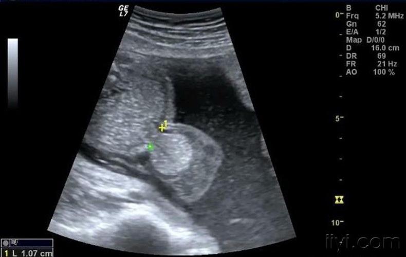 胎儿脐膨出典型病例 - 超声医学讨论版 - 爱爱医医学论坛 - 爱爱医