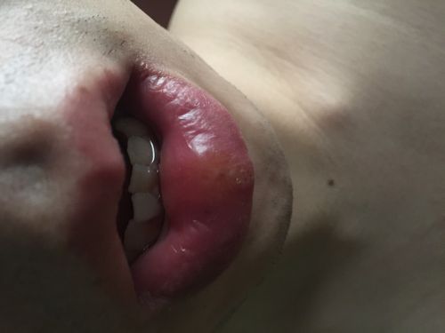 昨天早上醒来发现下嘴唇中间位置肿了一块,并且上面长了几个密集