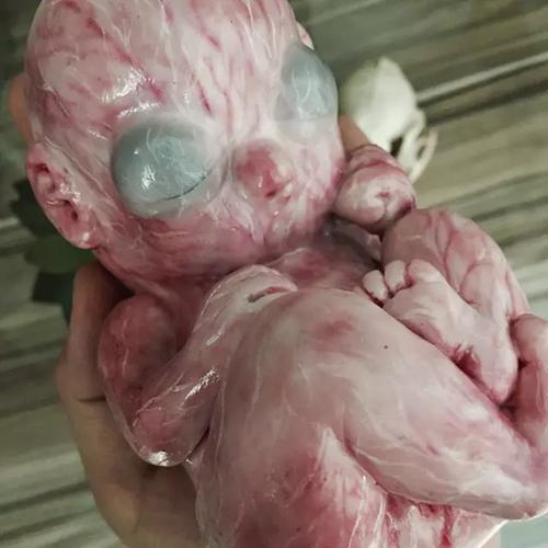 火棉胶婴儿是什么意思 1火棉胶婴儿是一种罕见的遗传病,婴儿出生时