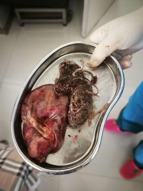 切除的卵巢畸胎瘤标本
