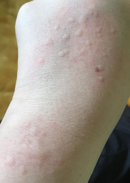 身上出现了很多像蚊子咬一样的包这到底是什么啊,特别痒,是过敏吗?