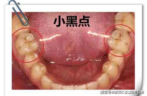 牙医的忠实警告:当你的牙齿出现小黑点时,要警惕啦!_手机搜狐网