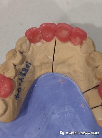 牙体解剖5上颌侧切牙