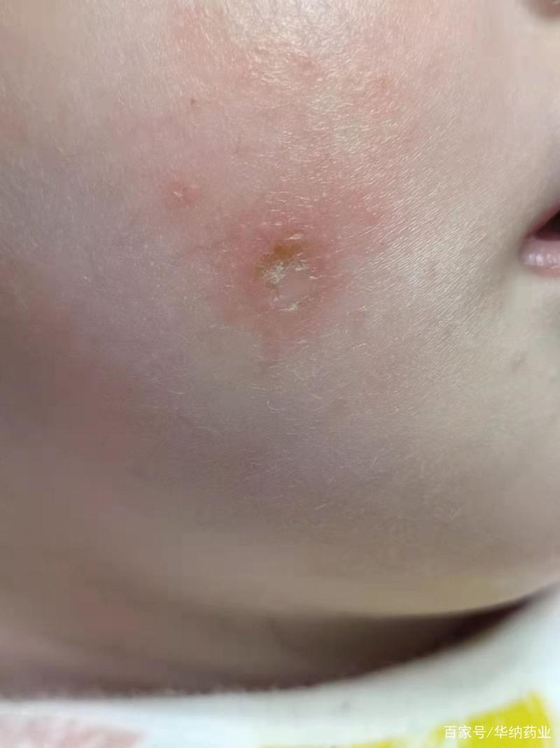 4个月宝宝脸部干性湿疹应该如何处理?