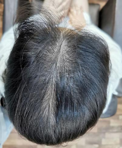 脱发发际线后移会面临秃头风险一定要改掉这3个坏习惯