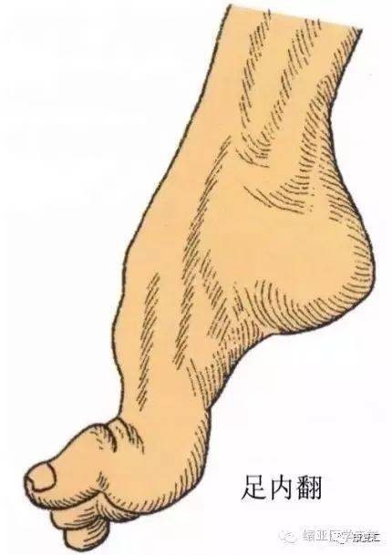 由于胫神经支配的小腿后侧肌群失去拮抗,会出现足下垂,足内翻,足趾微