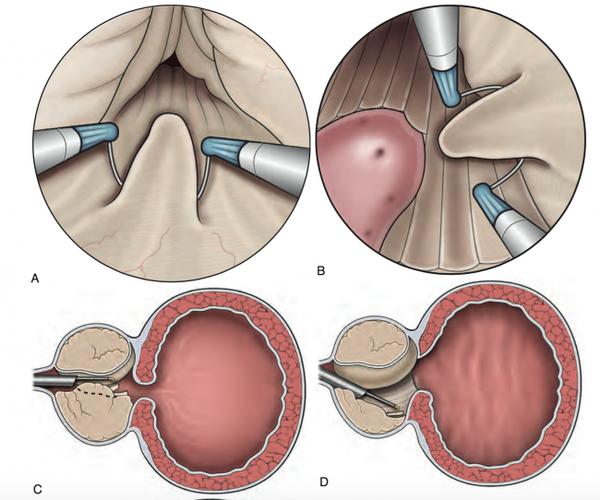 经尿道前列腺2微米激光切除术,经尿道前列腺红激光切除术,经尿道前列