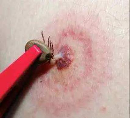 蜱虫叮咬后伤口图片被蜱虫叮咬后的正确处理方法