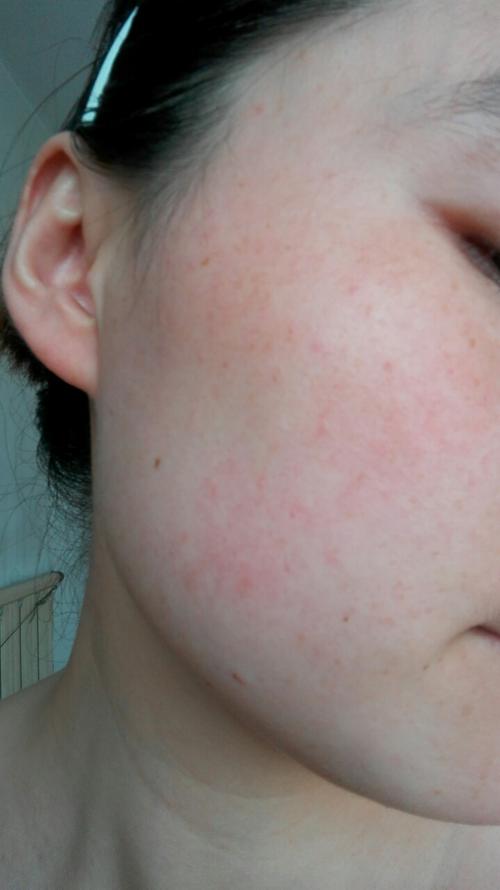 成人脸上湿疹怎么治疗?
