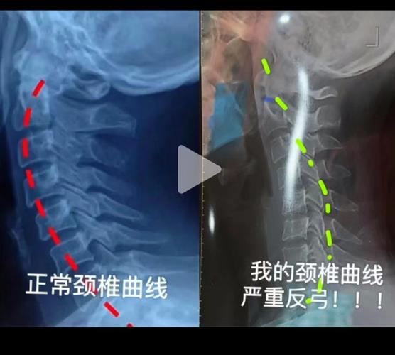 一位经常低头玩手机的女子的颈椎x光照片颈椎曲线变成反弓这危害非常