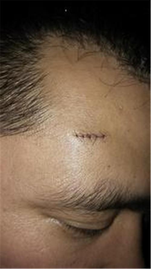 男子切除后额头脂肪瘤手术后疤痕图片