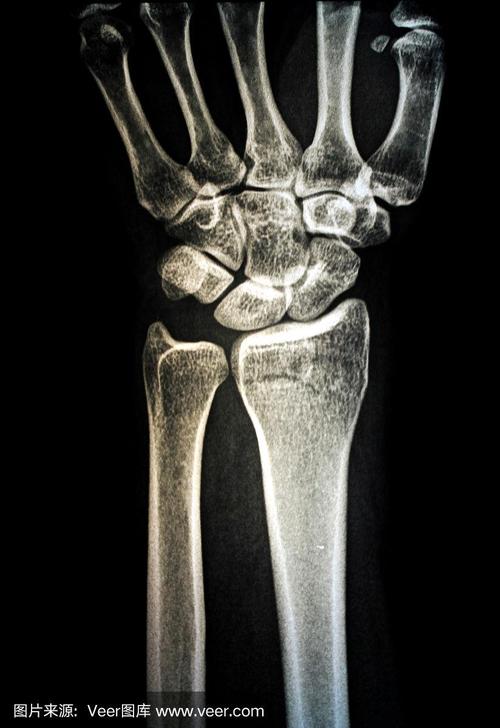 人类双手的x光图像