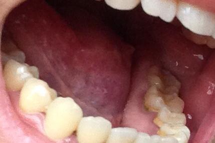 牙龈癌可不是牙龈瘤,严重会致命!致病原因可能还跟假牙有点关系