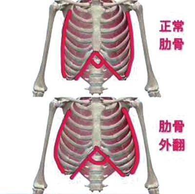 河南省儿童医院 王雪燕最近,王女士发现自己两岁的宝宝肋骨外翻