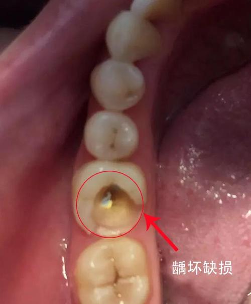 渡江口腔优秀病例展示慢性牙髓炎治疗