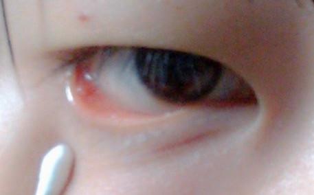 下眼睑内接近眼尾处有一块红色凸起的小肿块 不疼不痒的没有什么不适