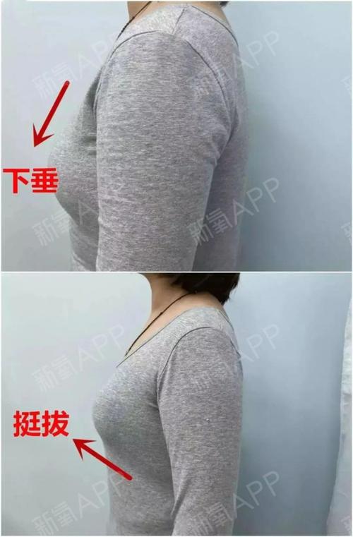 胸下垂后导致的左右不对称这种情况怎么出了呢?做悬吊提升还是隆胸?