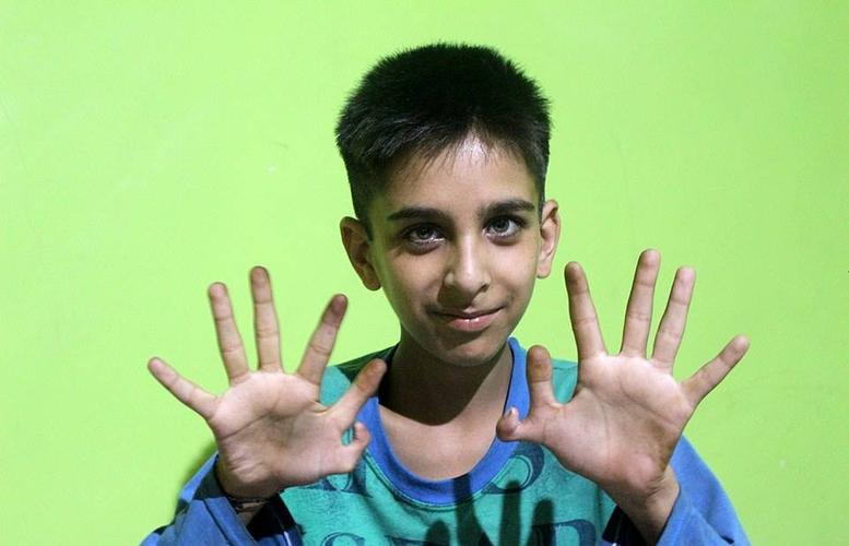 印度12岁男孩天生双手"六指"称有助于赢得电子游戏