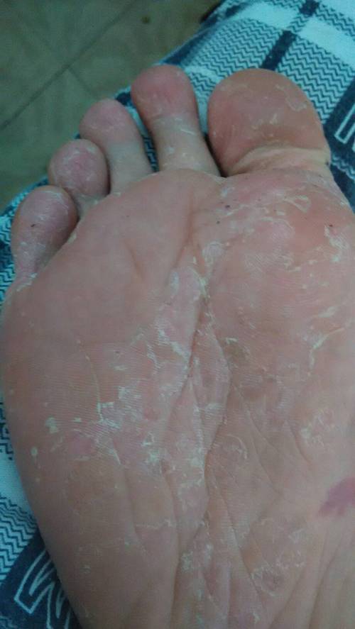 脚脱皮,不痛不痒有时候有水泡,是缺什么还是皮肤病?