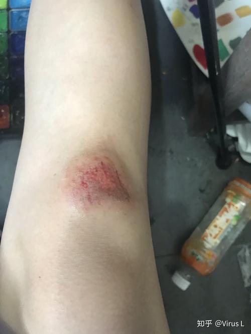 骑车侧翻膝盖摔伤破皮,怎么处理伤口,怎样才能不留疤? - 知乎