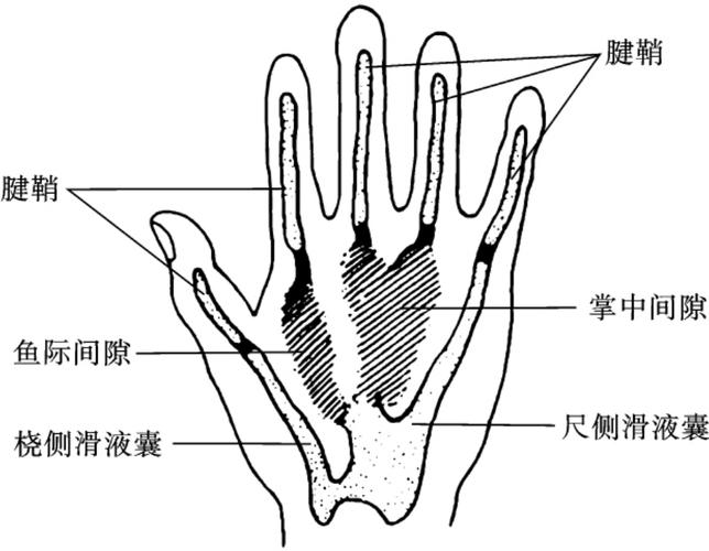 图3-4 手掌侧的腱鞘,滑液囊和深间隙【临床表现】掌深间隙感染均有