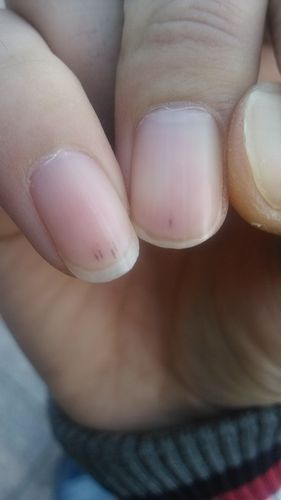 指甲盖有黑点是怎么回事?