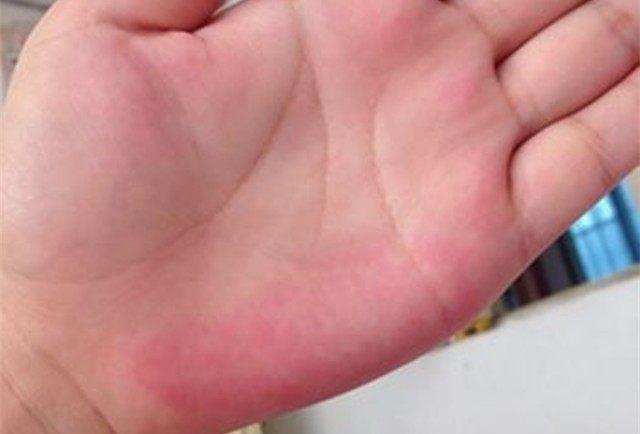 所谓"肝掌",是指手掌上出现红色斑点或是片块充血,用手指按压后变成