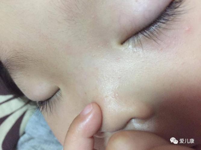 你问我来答问题一宝宝一岁7个月了,最近鼻子脸颊出了很多很小的痘痘