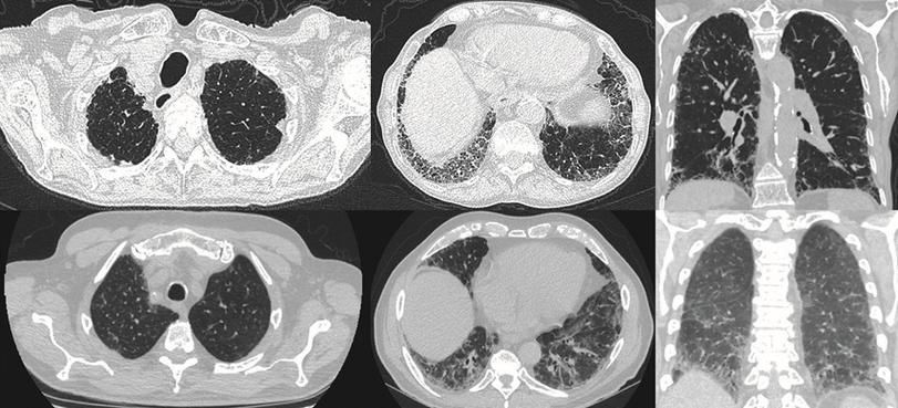 图六,图七 显示两肺外周蜂窝状影,近肺底部更明显影像表现:双肺斑片状