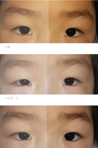 近日小角度上斜肌不全麻痹患者在徐州复兴眼科医院接受下斜肌后固定术
