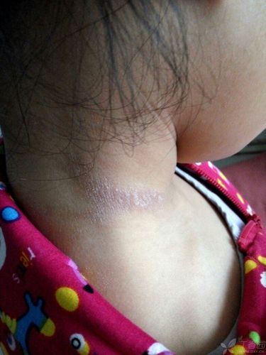 患儿 6岁 女孩 刚上一年级 颈部两侧皮损对称分布偶