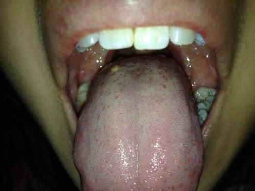 舌头中后部长了一个绿豆大小疙瘩,向外突出,很硬