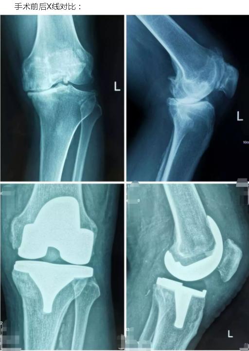 5度:严重骨磨损常有关节半脱位 而全膝关节置换,往往作为重度膝关节