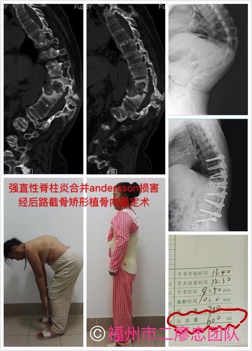 如何预防,治疗脊柱畸形和强直性脊柱炎"问题_我的网站