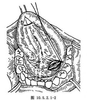 【颌下腺导管结石摘除术】颌下腺导管结石摘除术手术详细步骤,颌下腺
