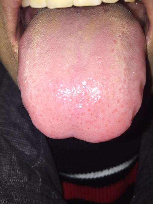舌根位置红疙瘩,舌尖位置有小红点,这是什么原因?