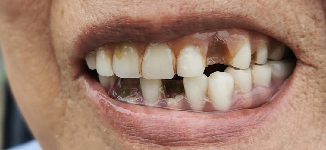 长沙暄美牙科门诊坑害老年人花费15万种植的牙齿反复掉