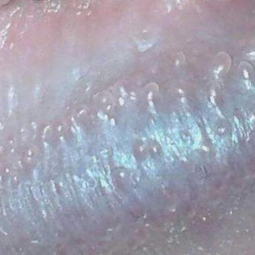 阴茎丘疹,是发生在龟头边缘阴茎冠状沟内的一种皮肤色或红色的小丘疹