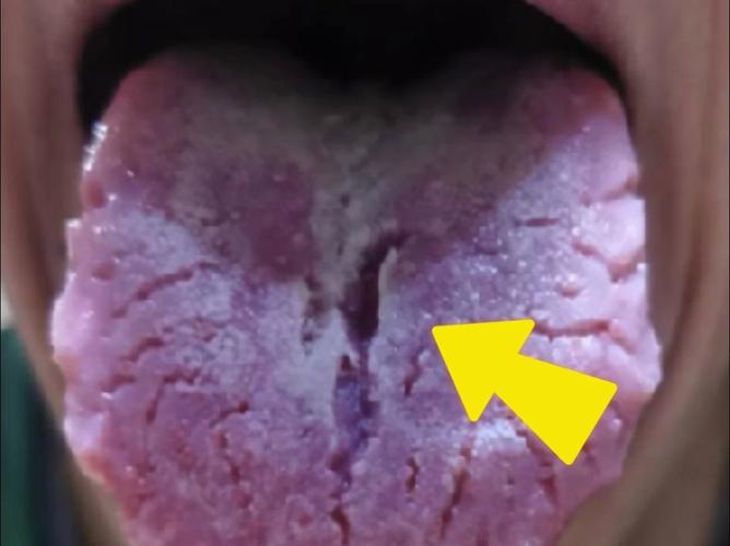 舌诊分析:出现这种裂纹舌,再不管住手,神医来了都没用!