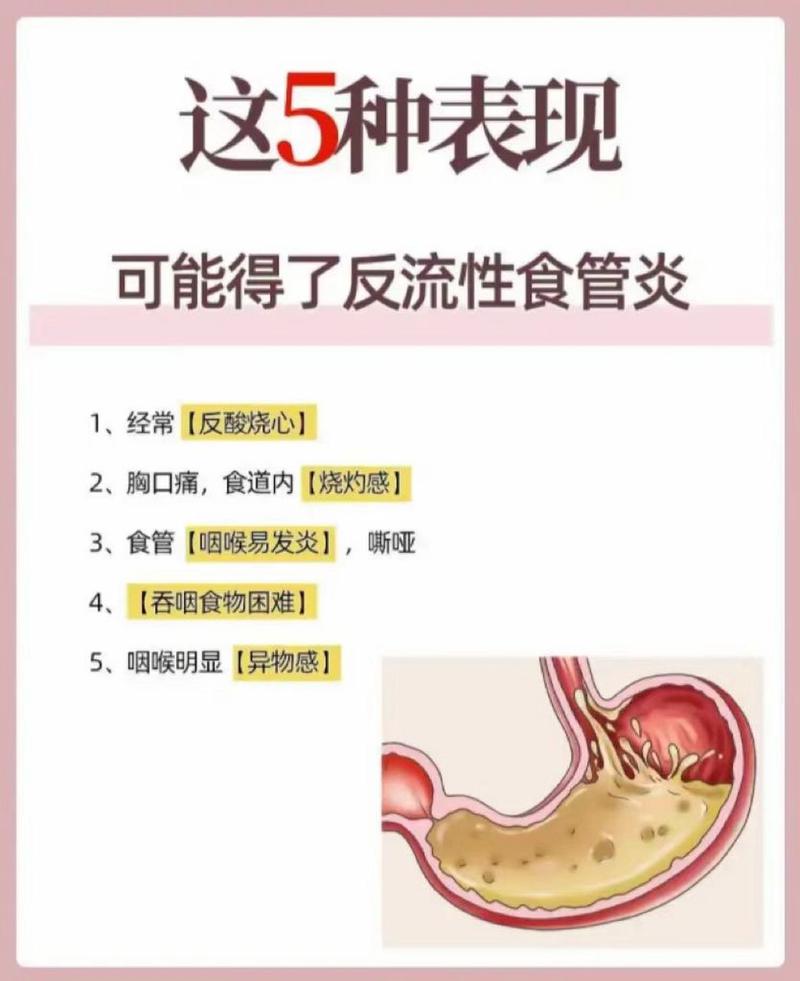警惕这5种表现,小心可能得了反流性食管炎 1,经常反酸烧心 2,胸口痛