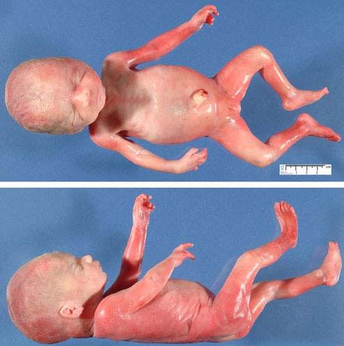 26周胎儿图28周胎儿图