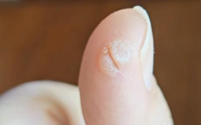 如果手上皮肤破损后皮肤增生的话那大概就是寻常疣了就是瘊子