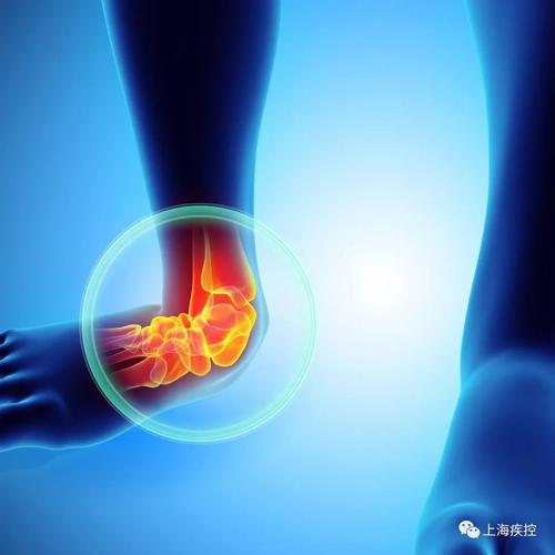 痛风导致的疼痛多发生在人体最低部位的关节,多在下肢,如大拇趾关节