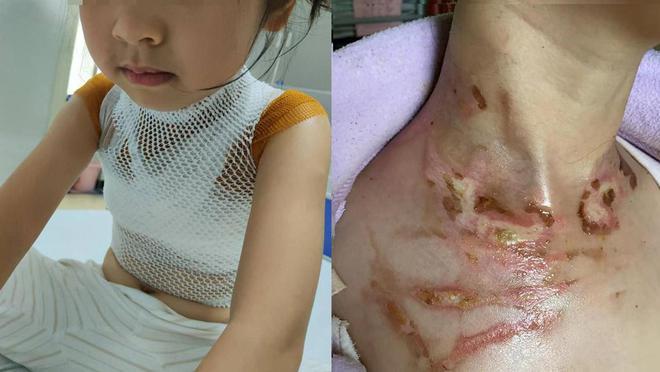 五岁女童在幼儿园遭二度烫伤,家长发抖音谴责被要求