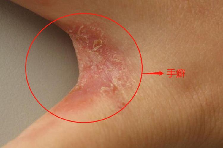 2,疥疮疥疮皮损多对称分布,表现为丘疹,丘疱疹,丘疱疹约小米粒大